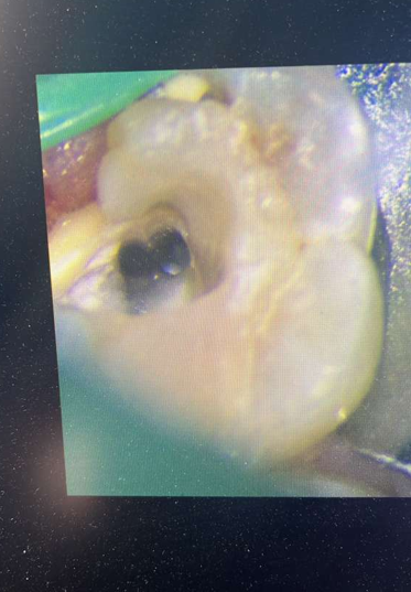 Before root canal treatment